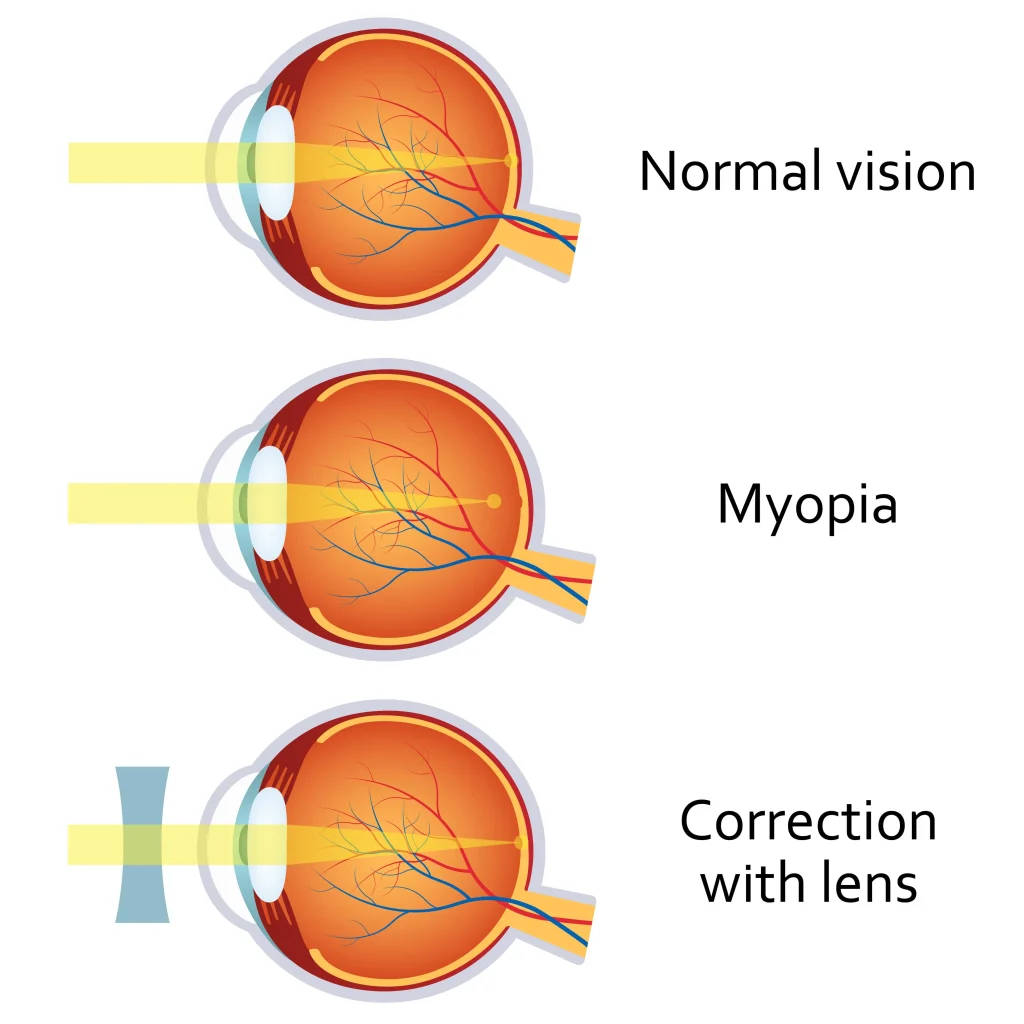 Myopia Control Long Beach CA image 1