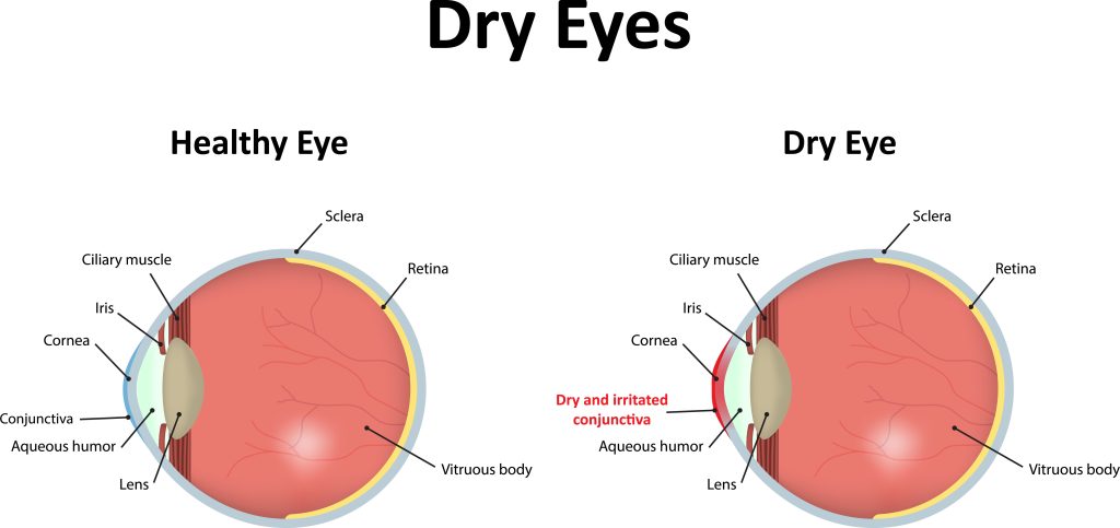 Dry Eye Disease Long Beach CA image 1